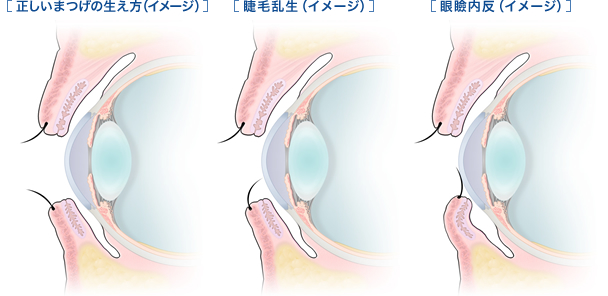 逆さまつ毛とは