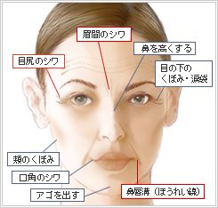 ヒアルロン酸注入はプチ整形の一種