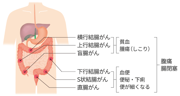 死因は『S字結腸がん』