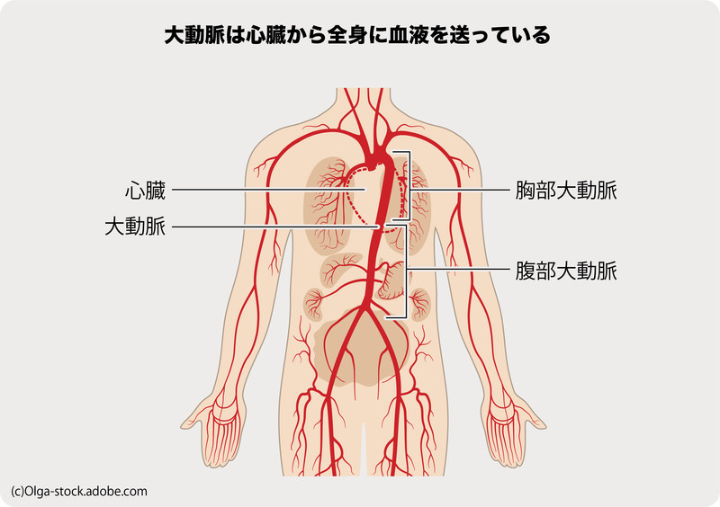 死因の急性大動脈解離とは