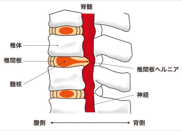 緒方恵美さんの病気「椎間板ヘルニア」とは…